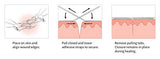 Clozex Emergency Laceration Closures - Repair Wounds Without Stitches. FDA Cleared Skin Closure Device for 3 Individual Wounds or Combine for Total Le