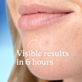 Differin Acne Prone Skin Patches 36ct