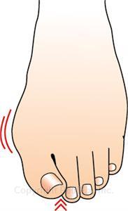 PediFix Podiatrists' Choice Bunion Relievers